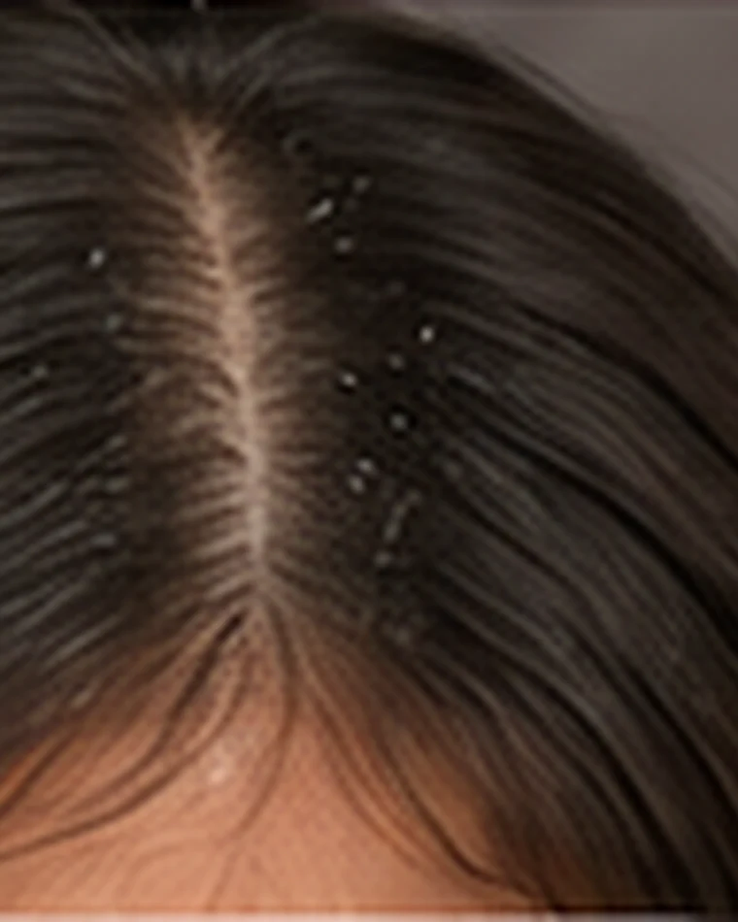 Cabello y cuero cabelludo que necesita cuidado anticaspa